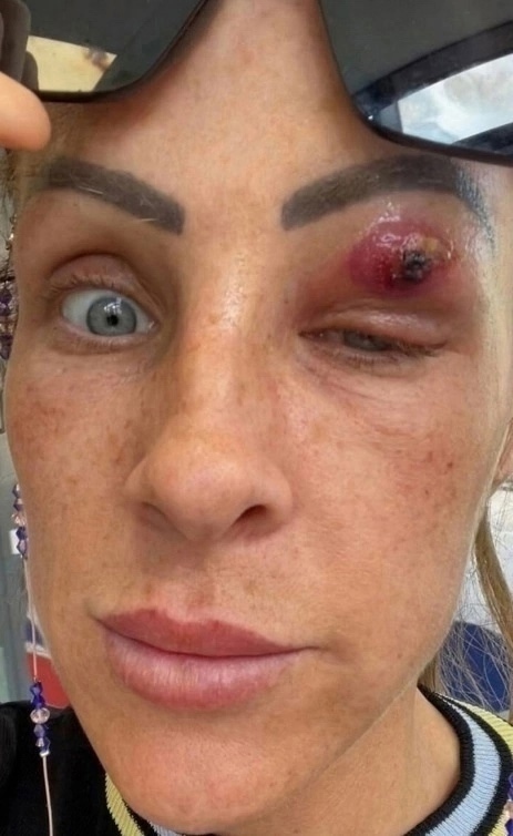 Однажды утром женщина заметила на правом веке странный прыщ, который, как ей показалось, начал увеличиваться в размерах. Веко оп…
