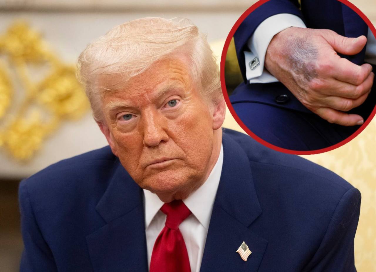 Дональд Трамп использует макияж, чтобы скрыть синяки на руках. Бывший президент США признался, что регулярно наносит тональное с…